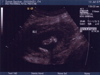 Second Ultrasound - Leg